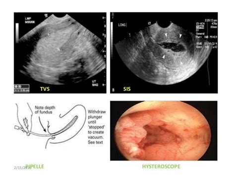 Endometrial hyperplasia