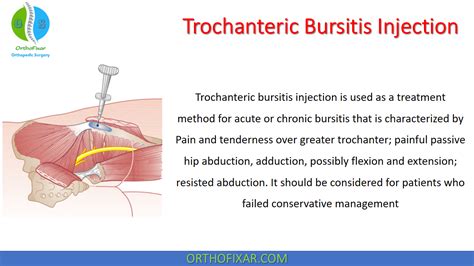 Trochanteric Bursitis Injection Technique