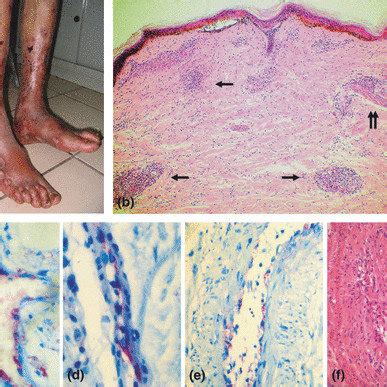 Typical skin lesions and underlying histopathology of diffuse ...