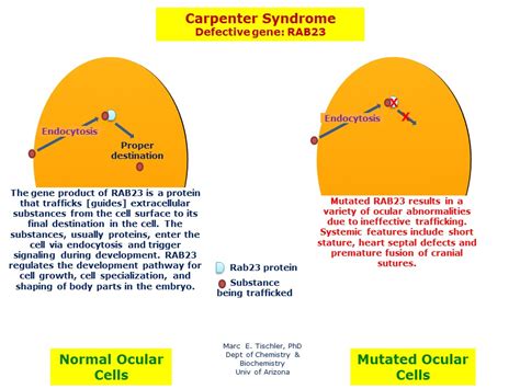 Carpenter Syndrome | Hereditary Ocular Diseases