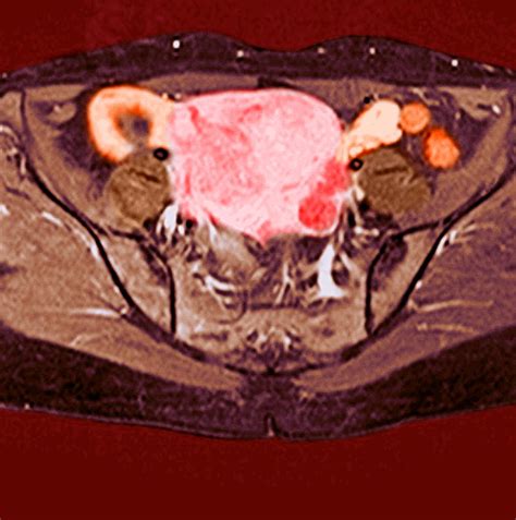 Uterine Fibroids