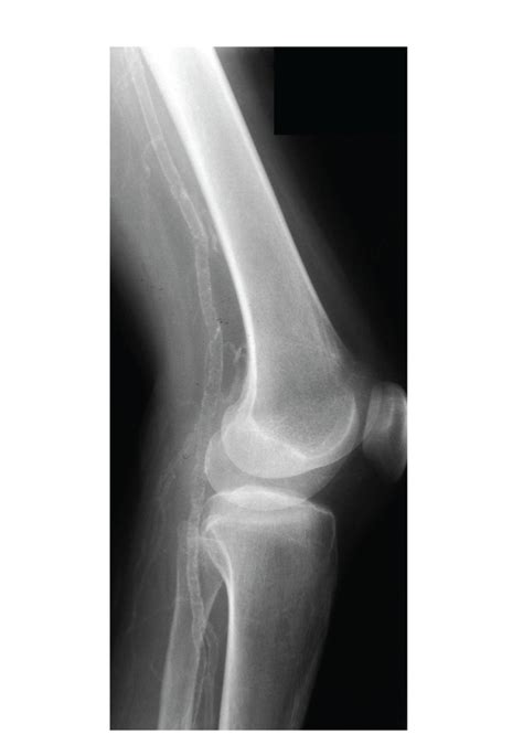 Plain radiograph of right leg showing diffuse vascular calcification of ...