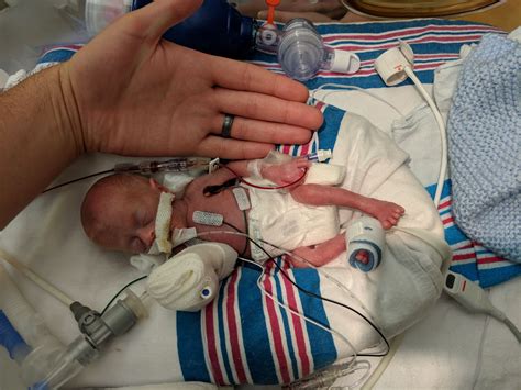 ‘Miracle Baby’: One of the smallest premature infants ever heads home