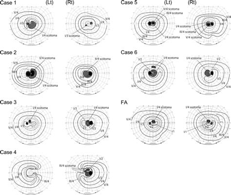 Goldmann visual field tests in Cases 1–6 and a case with fundus... | Download Scientific Diagram