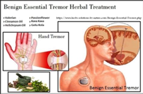 Tremor (Benign Essential Tremor)