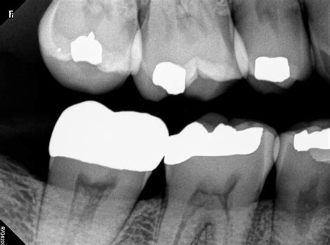 Root Canal X-rays Needed for Quality Treatment - Creekside Endodontics ...