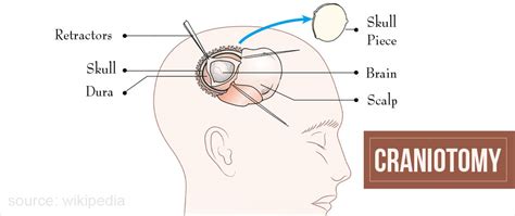 Craniotomy - Types, Indications, Procedure, Complications