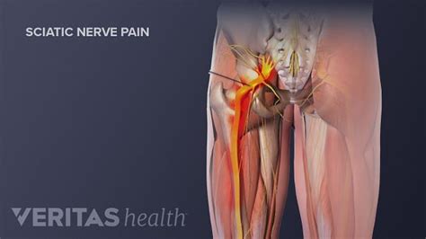 How Massage Can Ease Sciatic Pain