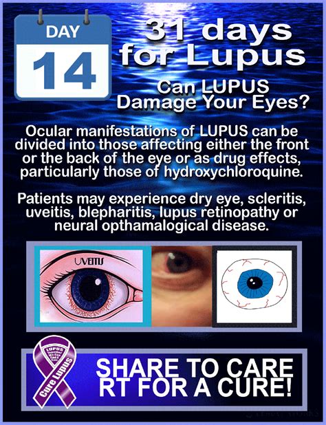 31 Days For Lupus! May is #LUPUSAwarenessMonth!! | Lupus facts, Lupus ...