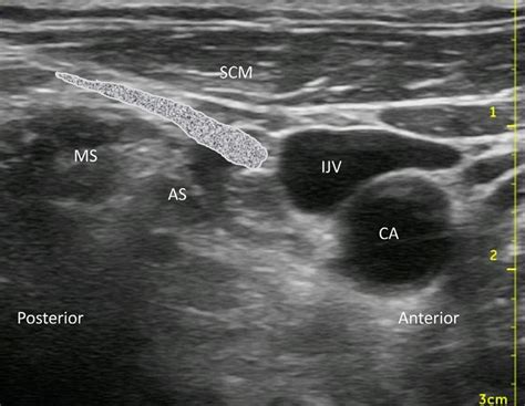 Lírico yeso Supresión cervical plexus block Por separado preocupación ...