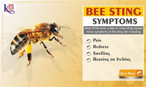 Bee Sting Allergy: Symptoms of Anaphylaxis