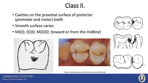 Blacks cavity classification for pit and fissure caries.pdf | Free Download