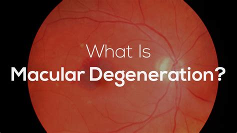 Macular degeneration - Age related, Causes, Types, Symptoms, Treatment