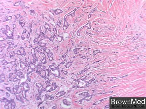 Invasive ductal carcinoma