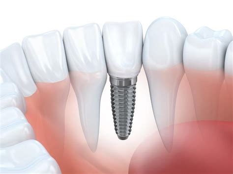 Dental Implants: Why They Are the Gold Standard for Replacing Missing ...