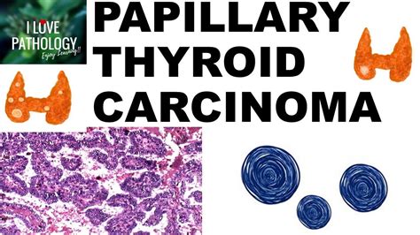 What Is Encapsulated Papillary Carcinoma? Best 7 Answer ...