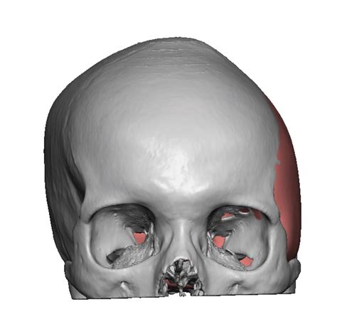 Plastic Surgery Case Study - Custom Skull Implant for Lop Sided Head Shape Correction - Explore ...