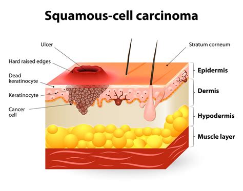 Basal Cell Carcinoma - Symptoms And Causes