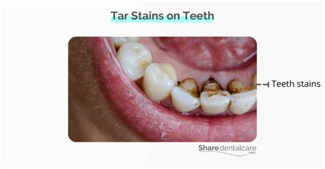 Tar Stains on Teeth - Share Dental Care