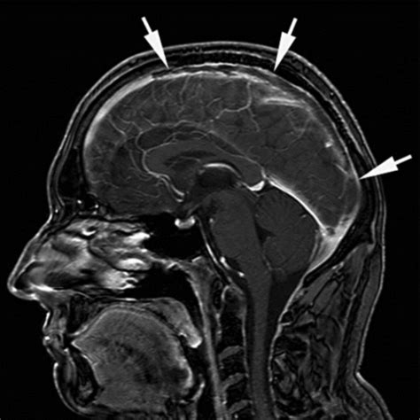 Cerebral sinus venous thrombosis in the superior sagitt | Open-i