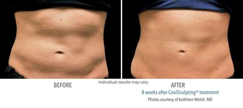 CoolSculpting before and after results from real patients - SCULPTDTLA.COM