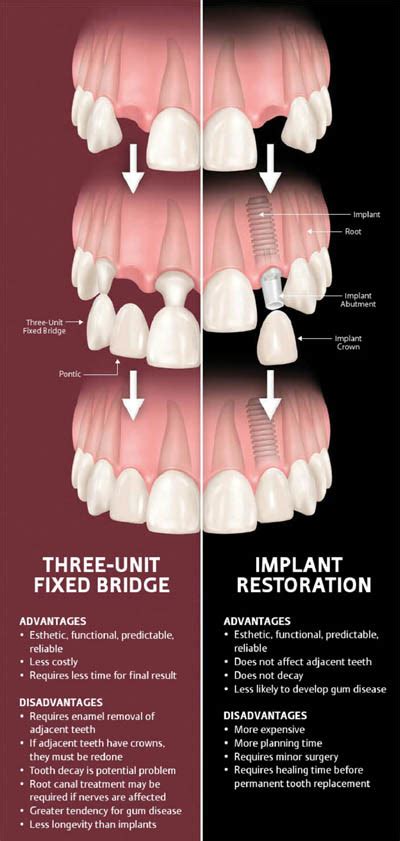 Dental Implants vs Dental Bridge - Let's Fill in the Gap! -Comfortdds