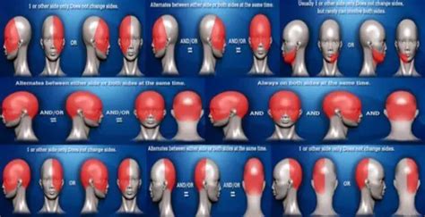 Location of Headache Meaning and Headache Placement Meanings on Headache Charts - Virtual ...