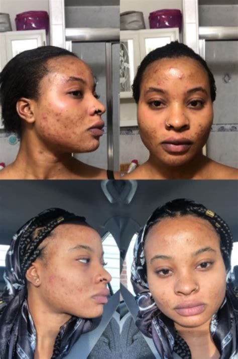 10 Face Masks With Before And After Photos That Will Make You A ...