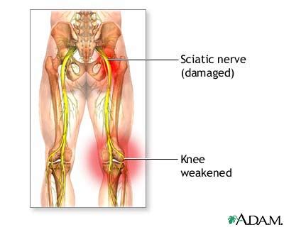 Sciatic nerve damage: MedlinePlus Medical Encyclopedia Image