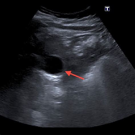 Bosniak 2F cyst flowchart. | Download Scientific Diagram