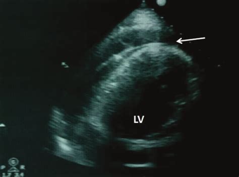 Echocardiographic imaging of pericardial effusion during the procedure ...