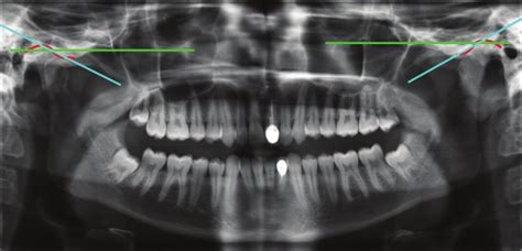 Panoramic radiograph of the patient showing the tracing of the angle of... | Download Scientific ...