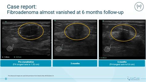 Breast Fibroadenoma Management: Treatment Without Surgery - IceCure