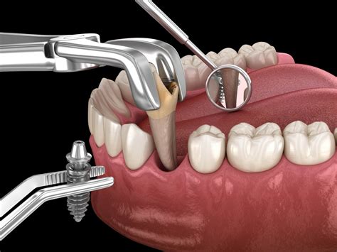 3 Approaches to Placing Implants After Tooth Extractions | Digital Denture + Implants | Los ...