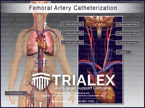 Femoral Artery Catheterization - TrialQuest Inc.