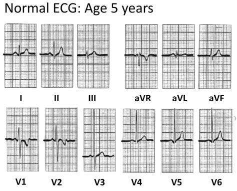 Paediatric ECG Interpretation • LITFL • ECG Library Basics