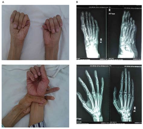 Thumb Sign In Marfan Syndrome - Captions Hunter