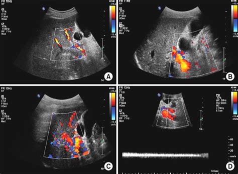 Porta Hepatis Ultrasound