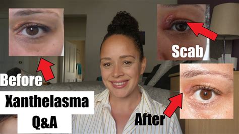 Xanthelasma Removal Surgery 9 Days Post Op