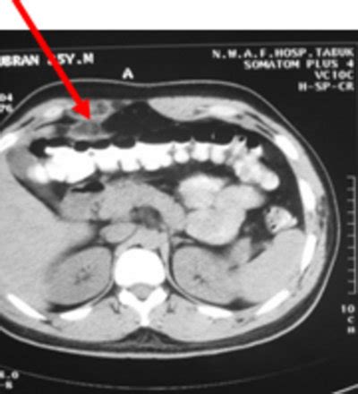 A: CT Scan Showing Acute Epiploicae appendagitis | Download Scientific ...