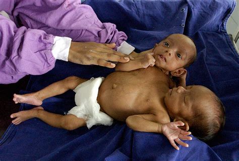 Can Conjoined Twins Live Normally? 19-Year-Old Indian Men Sharing One ...