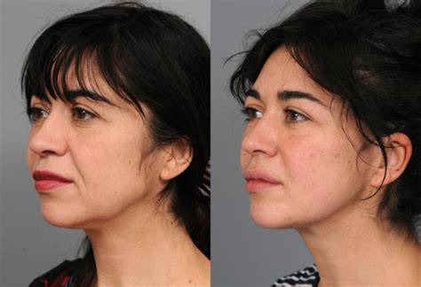 Five Facts About a Mini Facelift | Health Policy Monitor