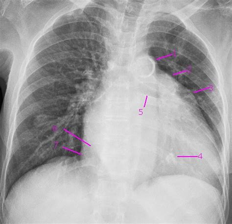 Mitral valve calcification – All About Cardiovascular System and Disorders