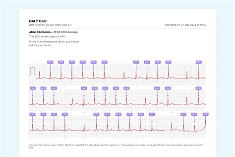 QALY | What Ectopic Atrial Rhythm Looks Like on Your Watch ECG