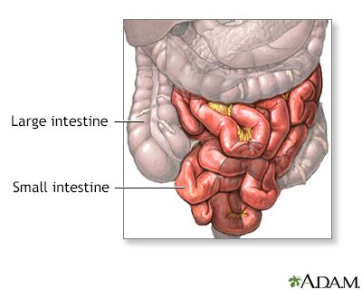 Small bowel resection Information | Mount Sinai - New York