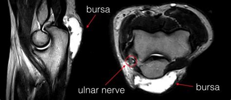 olecranon bursitis | coachingultrasound