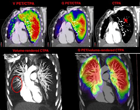 Patient with a normal CTPA scan and positive V/Q PET/CT scan. PET/CT ...