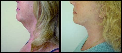 A Reason to Be Thankful: Turkey Neck Treatments that Work - California ...