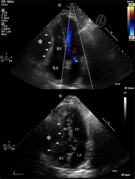 Apical Four Chamber Views Transthoracic Echocardiogram. These apical ...