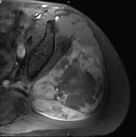 Tumor Surgery > Tumor Education > Soft Tissue Tumors > Soft Tissue Tumor Types ...